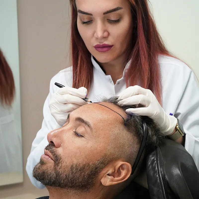 fue-hair-transplant
