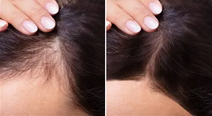 rambut botak pria-wanita