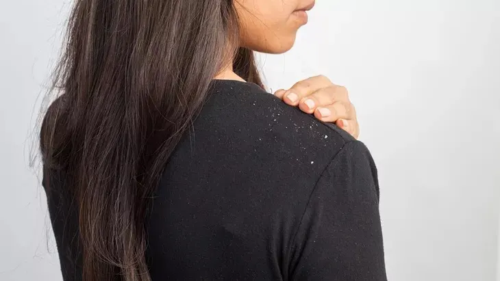 serpihan putih di baju
