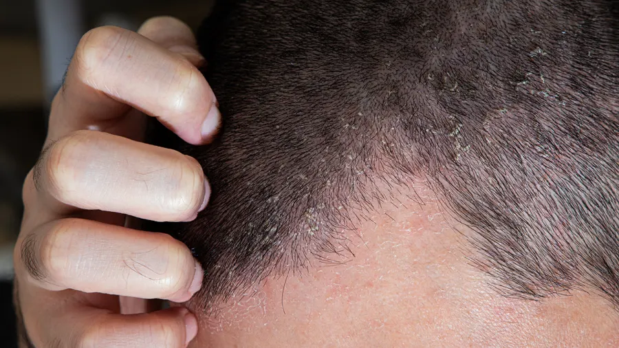 Dermatitis Seboroik