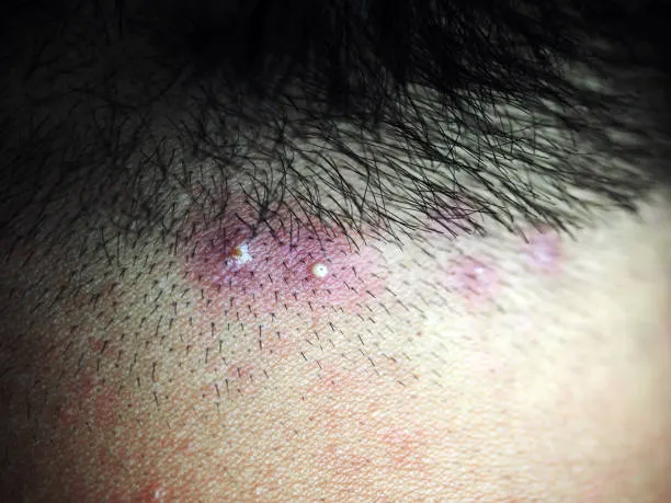 Folikulitis di rambut