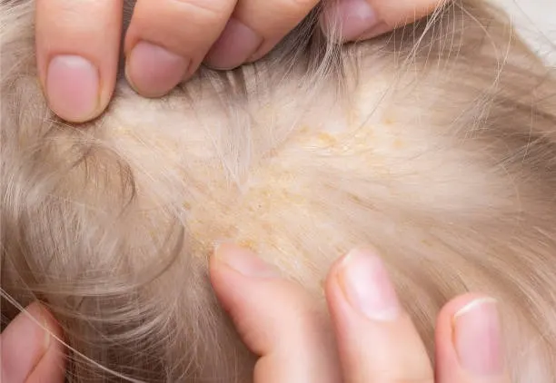 infeksi jamur pada rambut