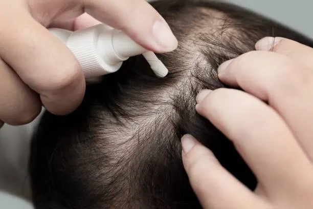 rambut menipis