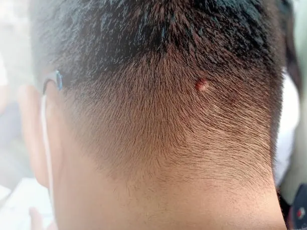 kutil pada kulit kepala