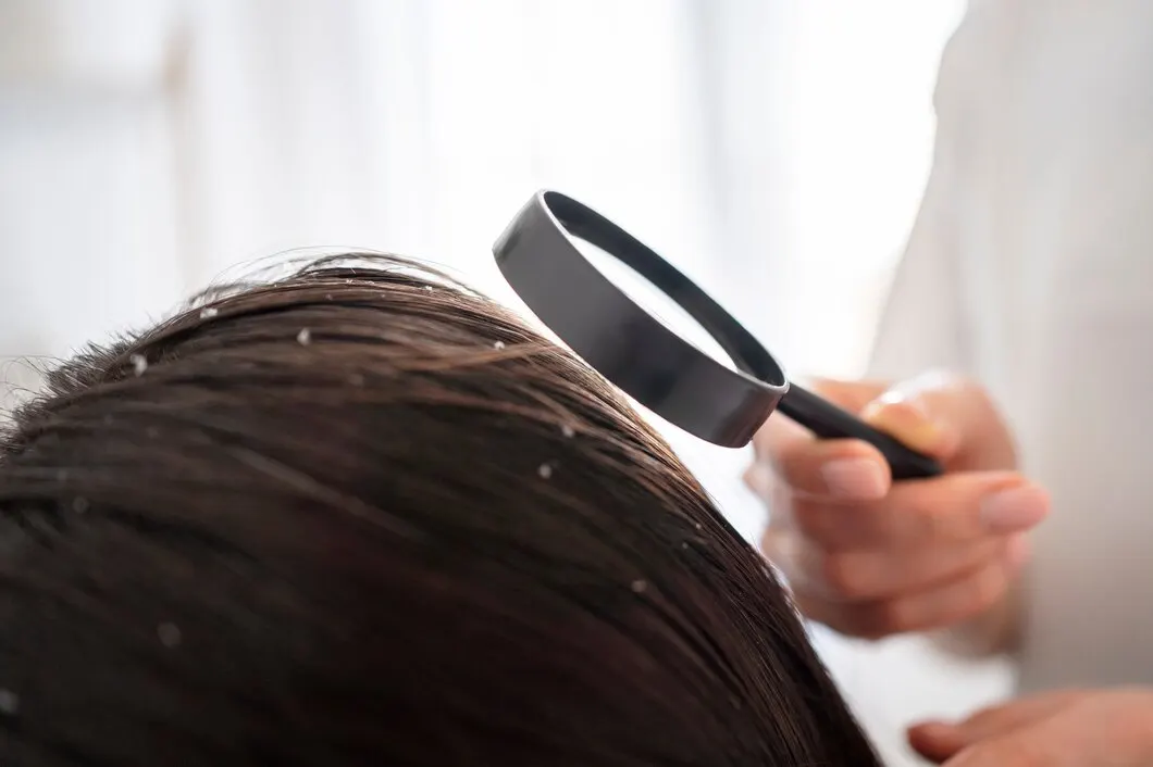 Cara Memilih Conditioner yang Tepat untuk Kulit Kepala Rentan Ketombe