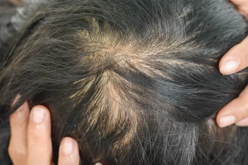 Mitos dan Fakta Seputar Penipisan Rambut: Apa yang Benar?