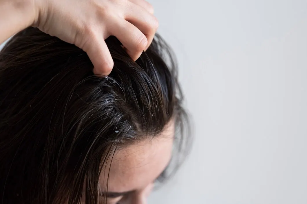 Perbedaan antara Ketombe dan Dermatitis Seboroik
