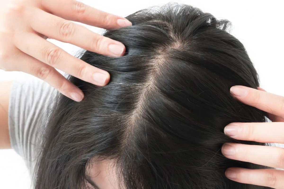 Mengapa Sampo Anti-Ketombe Tidak Selalu Cukup? Coba Cara Ini Agar Ketombe Hilang Total!