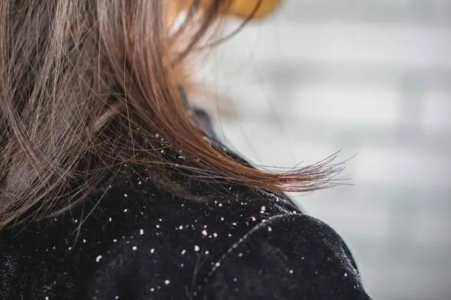 Shampo Anti-Ketombe Terbaik: Pilihan & Rekomendasi untuk Rambut Bebas Gatal!