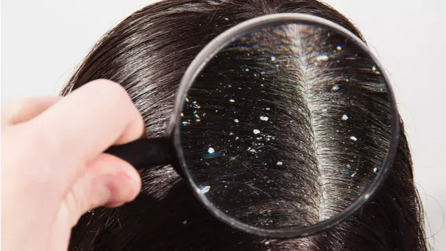 Kebiasaan Sehari-hari yang Tanpa Disadari Bikin Ketombe Makin Jadi-jadi