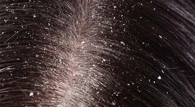 Mengapa Ketombe Muncul? Ini Penyebab dan Cara Mengatasinya