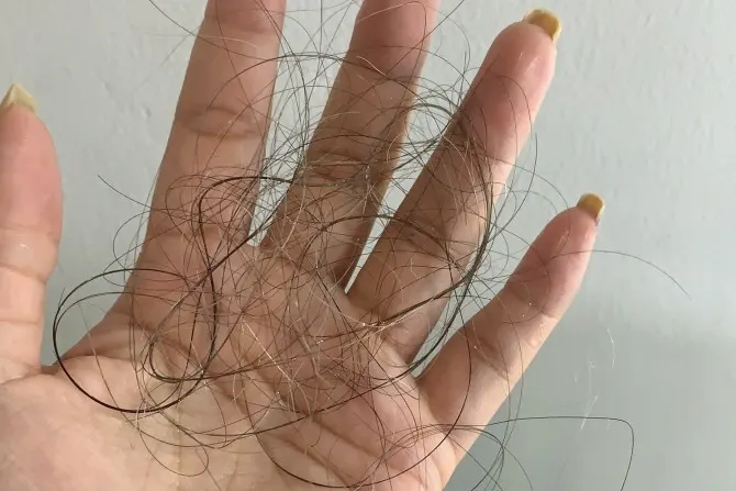 Stres Bikin Rambut Rontok? Yuk, Atasi dengan Cara Santai Ini!