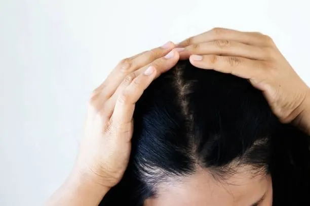 Stres dan Kulit Kepala: Sahabat Karib yang Kurang Menguntungkan