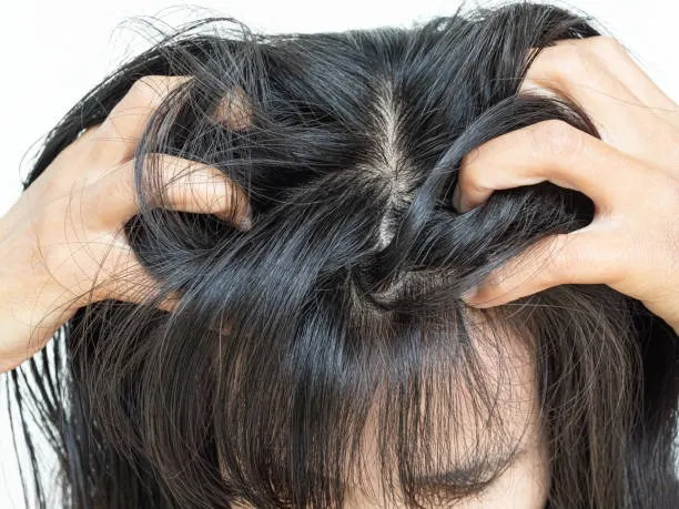 Mengatasi “Jamur Rambut” dengan Santai: Penyebab, Gejala, Pengobatan, dan Tips Cegahannya