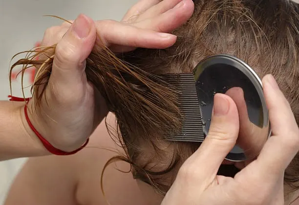 Kutu Rambut: Musuh Kepala yang Makin Bikin Betah
