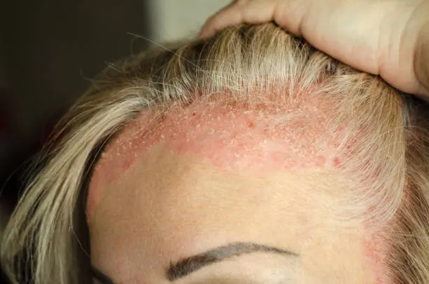 Rahasia Kulit Kepala Sehat untuk Rambut Tetap Kuat dan Bersinar