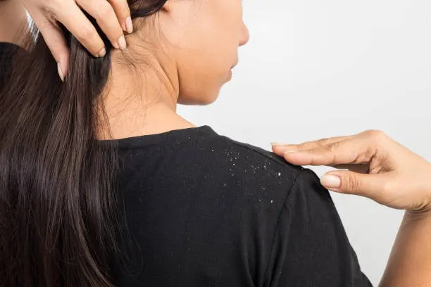 Perawatan Rambut yang Tepat untuk Menghindari Ketombe