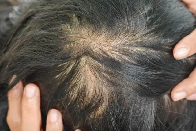 Mitos dan Fakta Seputar Penipisan Rambut: Apa yang Benar?