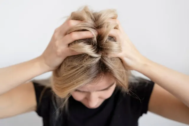 Rambut Bebas Ketombe dalam Seminggu: Ini Langkah-Langkahnya!