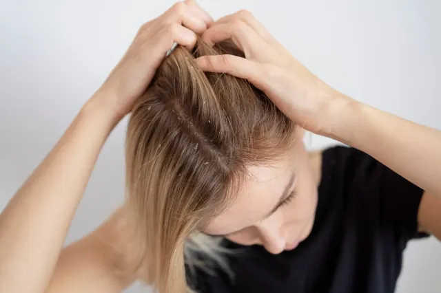 Rambut Sehat dan Bebas Ketombe: Ini Dia Tips dari Para Ahli