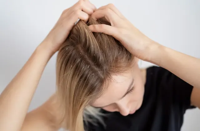 Hati-hati! Kebiasaan Sepele Ini Bisa Memicu Ketombe di Rambut