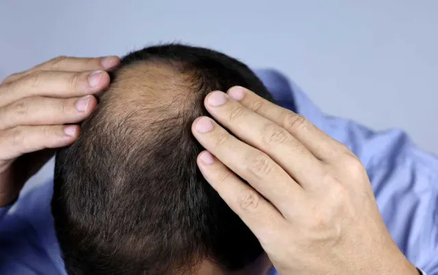 Vitamin dan Nutrisi Penting untuk Cegah Kebotakan: Rambut Lebih Kuat, Kepala Lebih Percaya Diri!