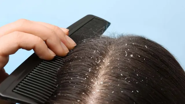 10 Cara Alami Usir Ketombe Tanpa Bahan Kimia (Bisa Pakai Bahan Dapur!)