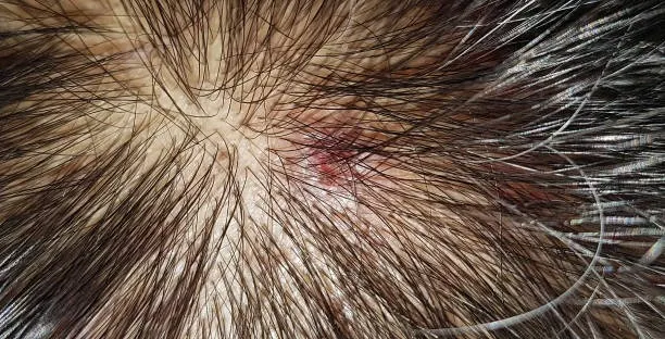 Rambut Gak Nyaman? Ini Solusi Buat Kulit Kepala Sensitif!