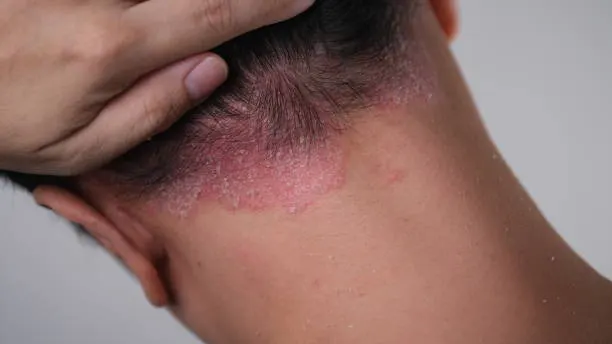 Kapan Harus ke Dokter Spesialis Kulit untuk Masalah Rambut?