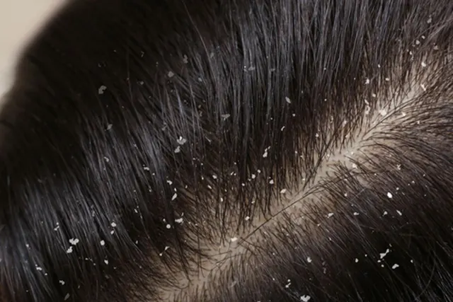 Cara Merawat Kulit Kepala untuk Mencegah Ketombe dan Menjaga Rambut Tetap Sehat