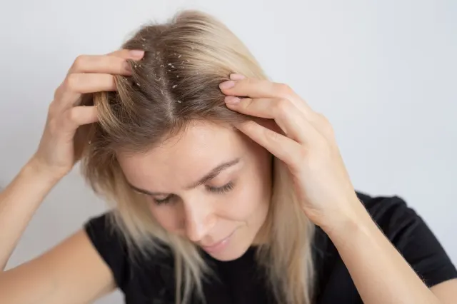 Ketombe Bisa Bikin Rambut Rontok? Ini Penjelasan Medis dan Cara Ampuh Mengatasinya